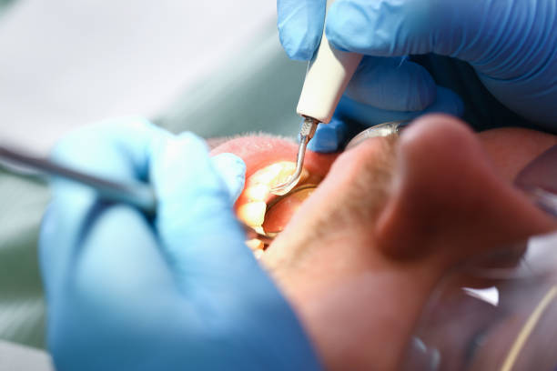 Best Emergency Tooth Extraction in Chevy Chase Village, MD